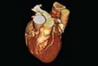 CT Heart Angiogram Scan CTA